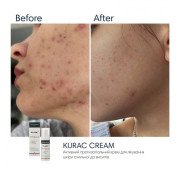 Braderm Kurac cream Активний протизапальний крем з Бензоїл пероксидом 4%