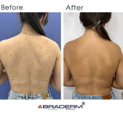 Braderm Dorsak spray Активний протизапальний спрей з Бензоїл пероксидом 6%