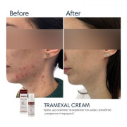 Braderm Tramexal cream Освітлююча емульсія проти пігментації