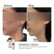 Braderm Tramexal cream Освітлююча емульсія проти пігментації