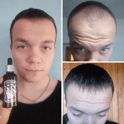 MINOX Лосьйон мінокс 15%