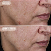 Image Skincare Ageless+ Retinol Pure Liquid Retinol 0.75% Концентрат чистого ретинолу 0,75%